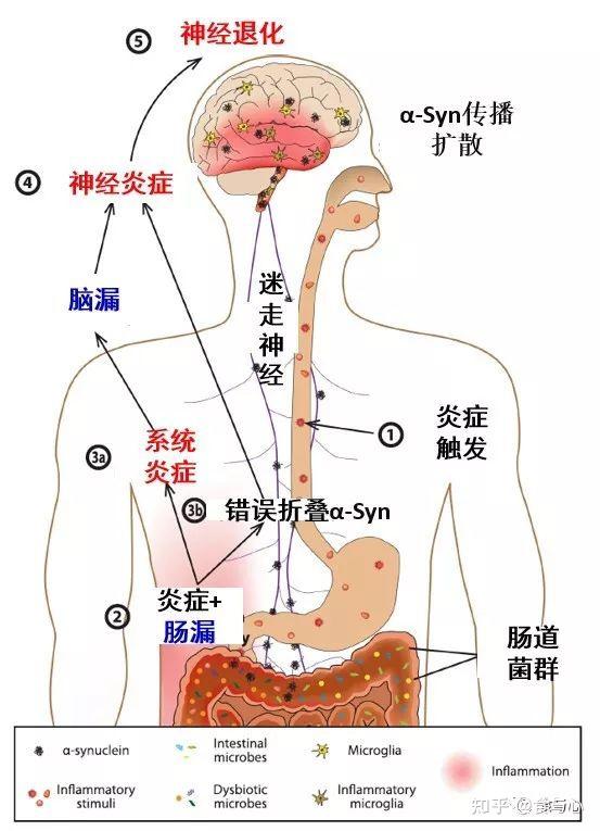 腸漏你必須知道的熱知識5腦漏老年痴呆和神經退行病變