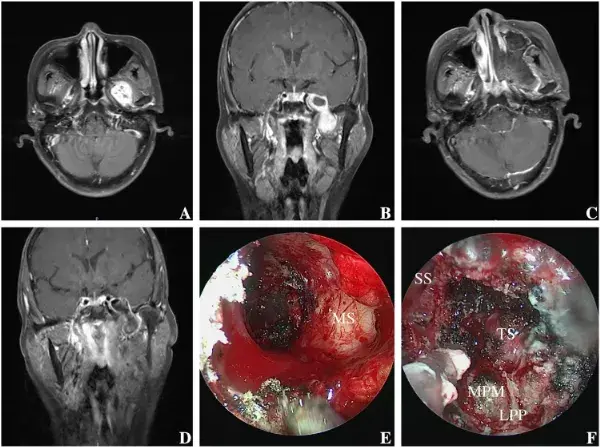 術前mri-t1加權成像顯示左顳底巨大腫瘤伴囊性變,佔據顳下窩和meckel