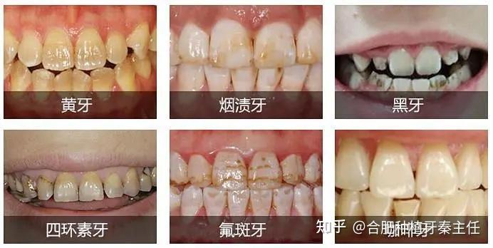 四环素牙,氟斑牙,黄牙等都可以改善让你拥有洁白的牙齿自信的展现笑容