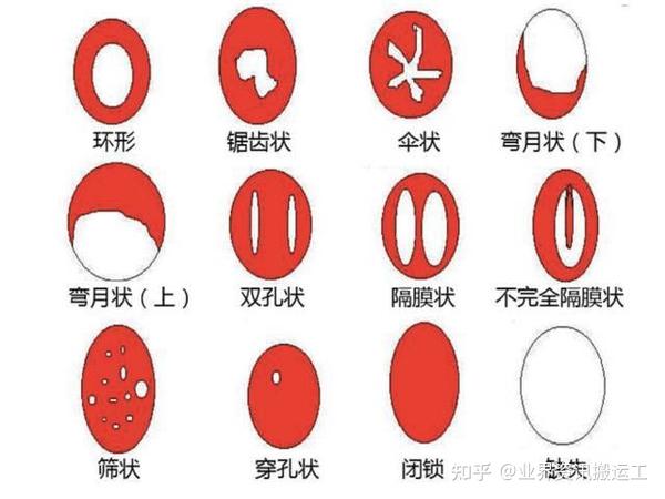 细说处女膜【处女膜的各种形态】有人天生没有膜,有人天生石女需要手术弄破 - 知乎