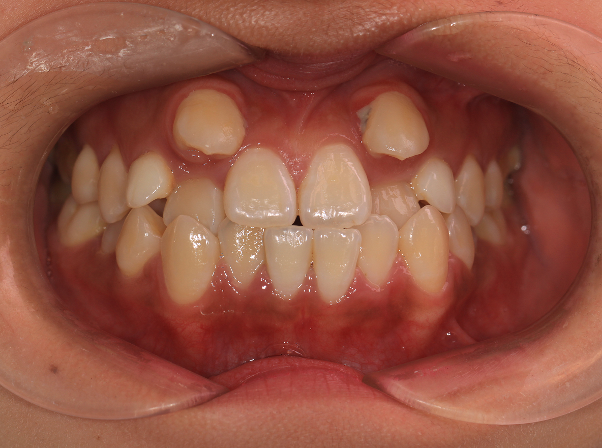 牙齿畸形 恐怖图片