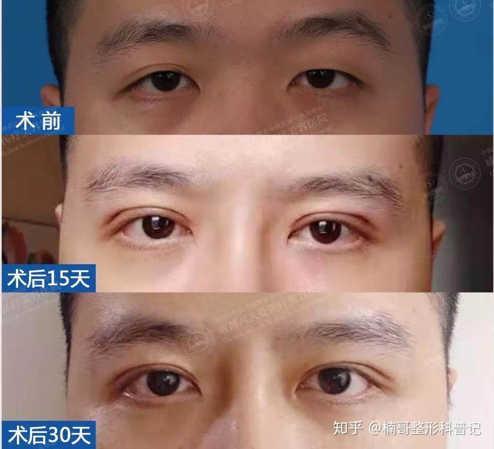 别再说想做个眼综合了，1分钟了解「眼整形」各项术式！ - 知乎