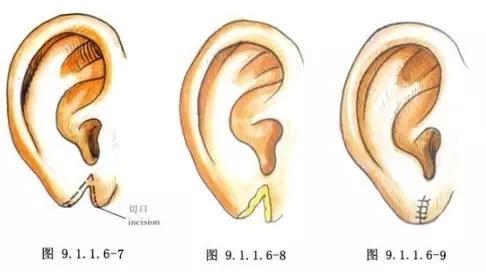 图解几种耳垂畸形修复术