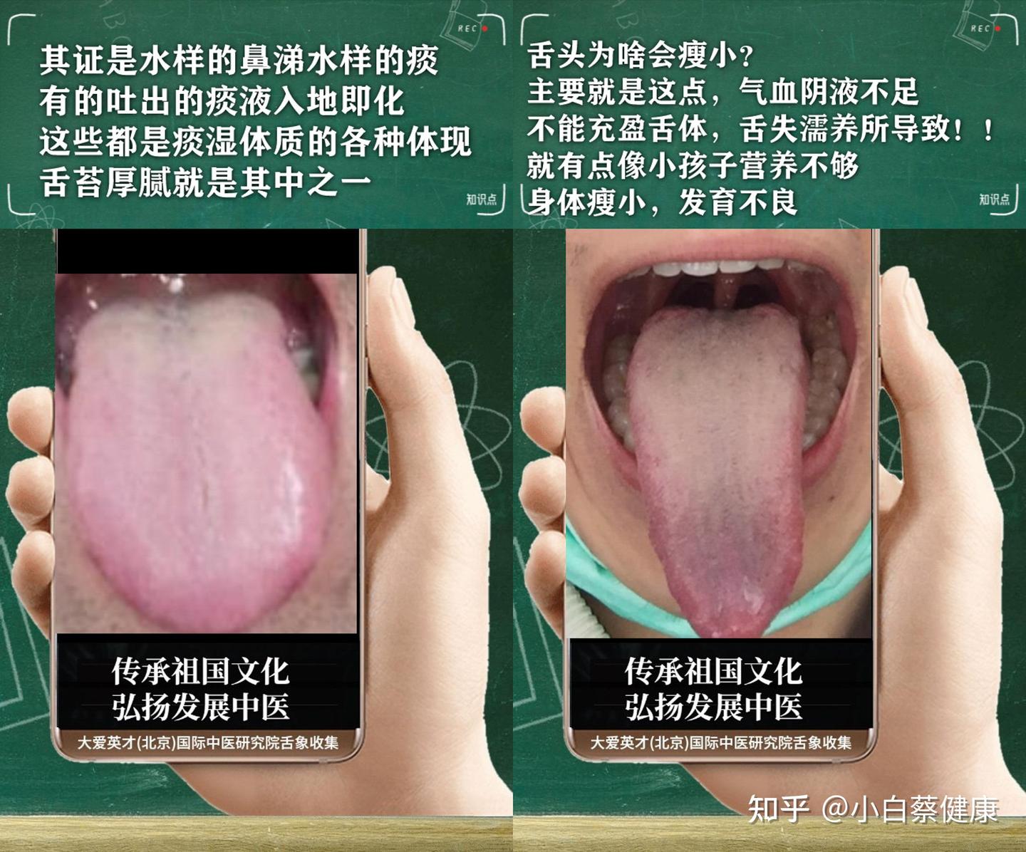 中医解剖:痰火扰心,不思饮食,嗳气,便秘,经常反复很难受 - 知乎