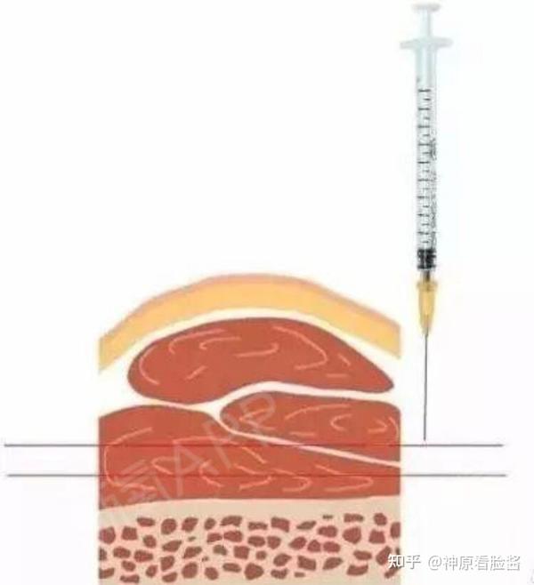 最全功课i关于肉毒素 看这一篇就够了 知乎 最全功课i关于肉毒素 看这一篇就够了 知乎
