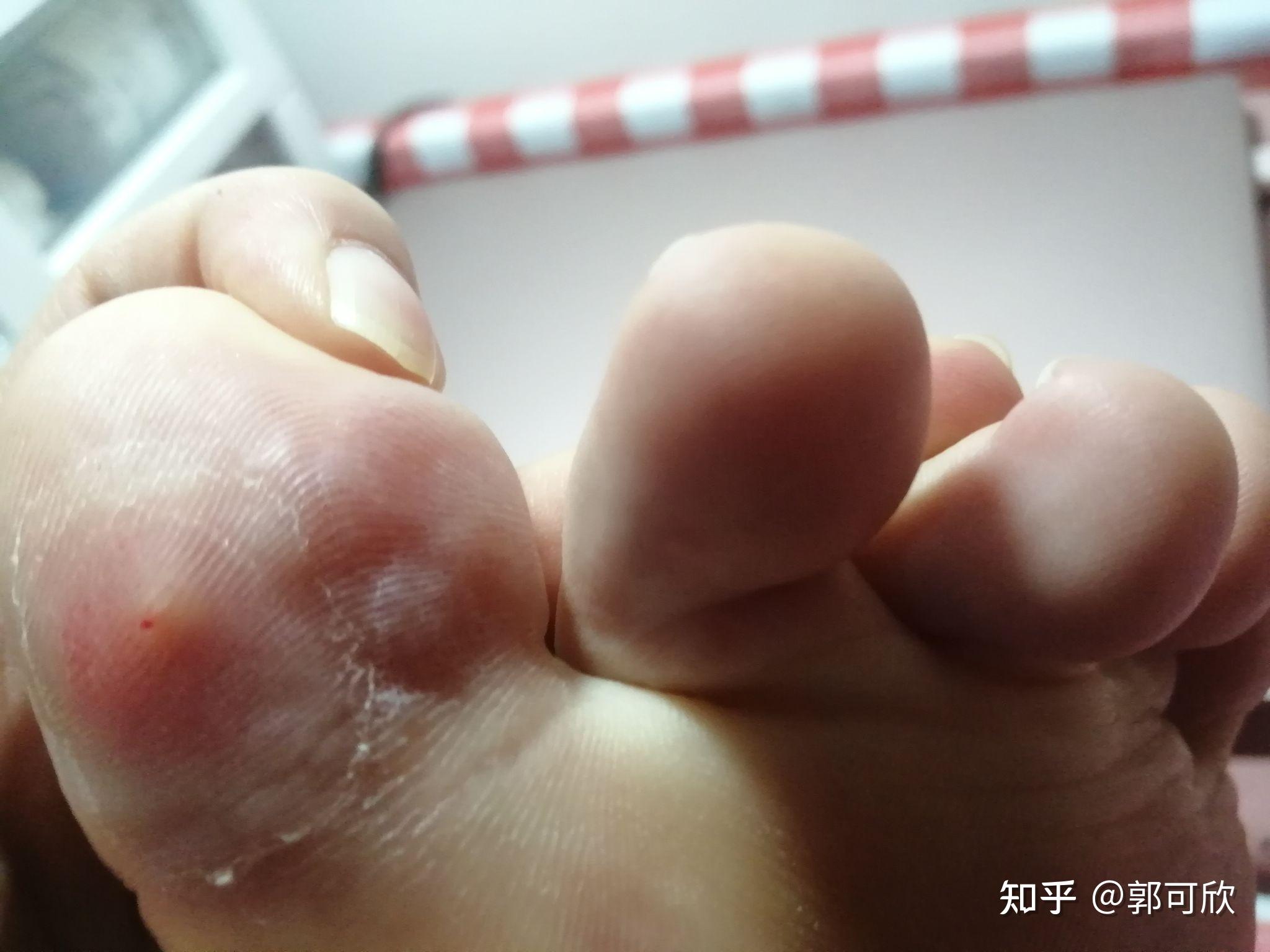 液氮冷冻鸡眼治疗贴. - 知乎