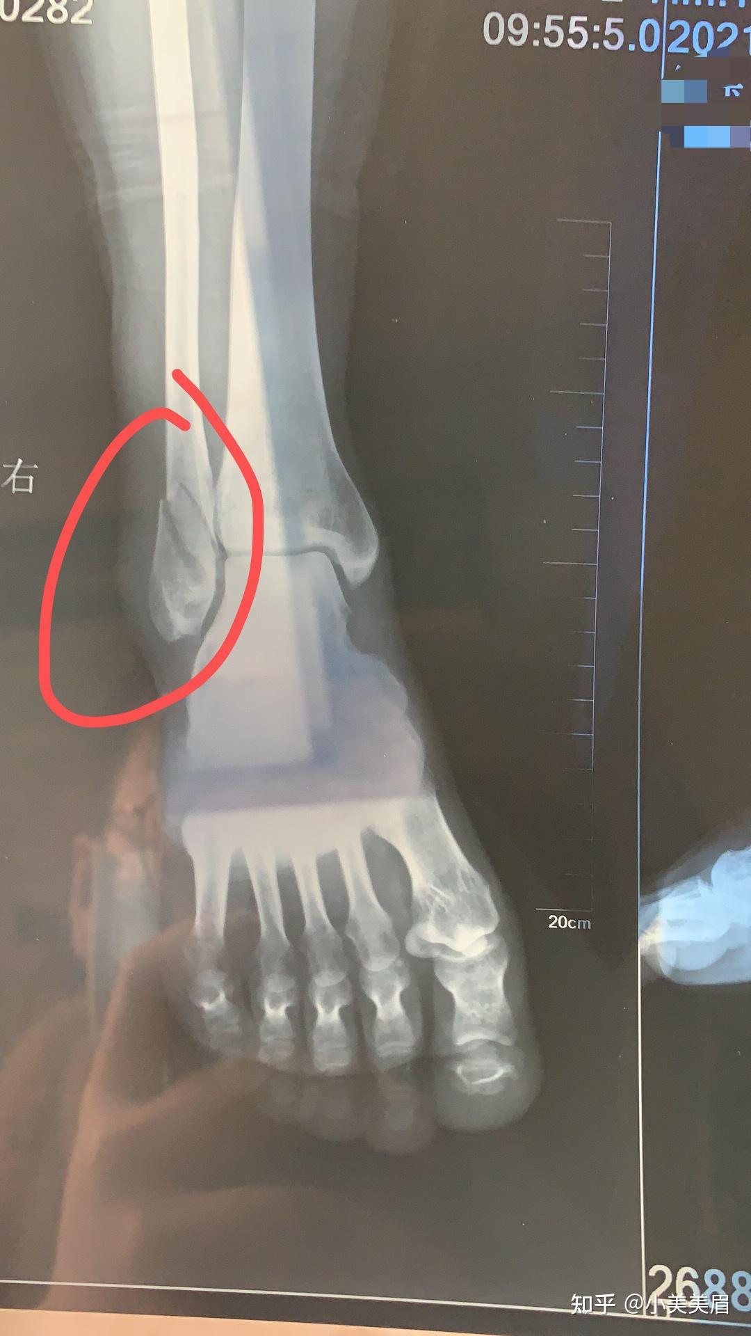 右外踝骨折长骨痂图片图片