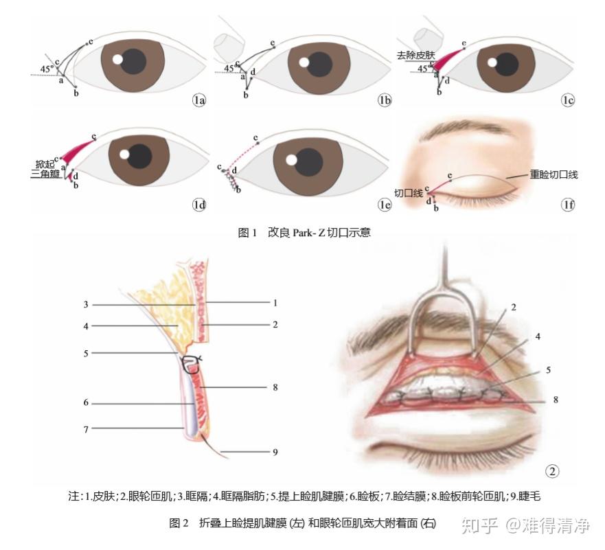 什么是内眦赘皮?到底需不需要开眼角? - 知乎