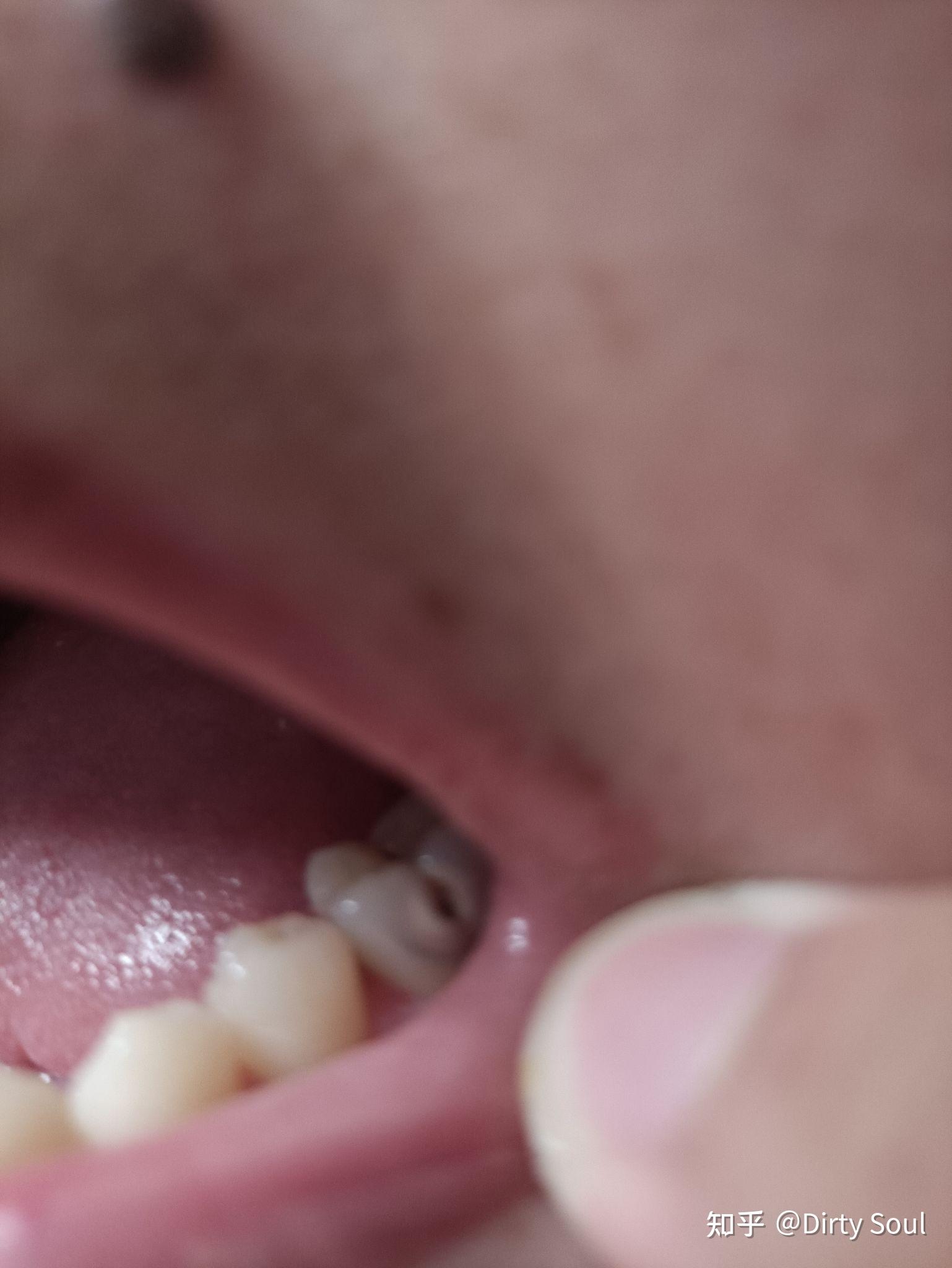 高雄牙醫，高雄牙齒重建，高雄植牙推薦|牙裂植牙重建案例-新悅美學牙醫診所