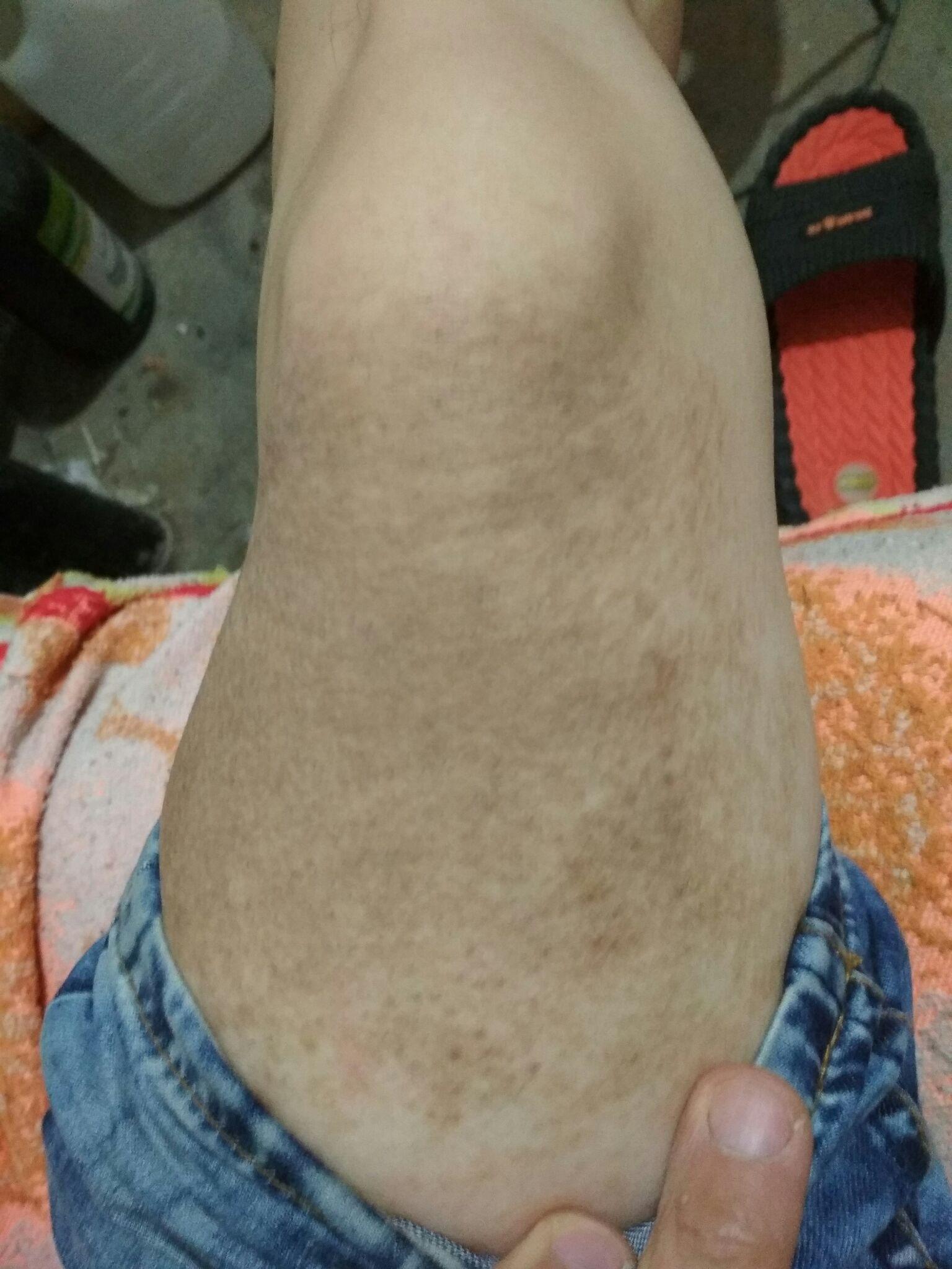 大概在十五六岁的时候吧腿上长出这些黑斑有黑色的汗毛不知道是什么