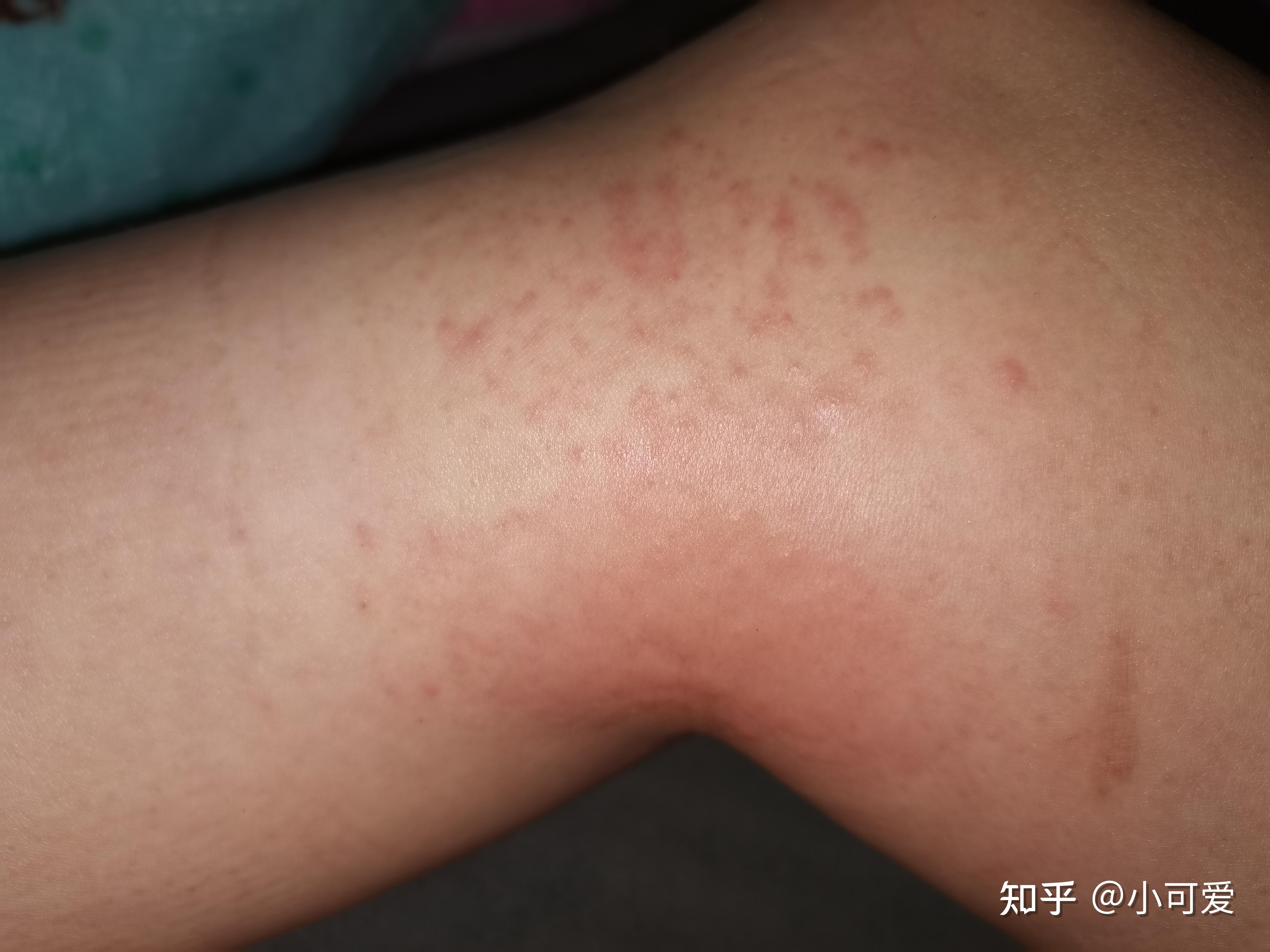 膏药过敏引发的过敏性皮炎治疗心酸历程(有图做好心里准备) - 知乎