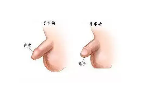 家有男宝的烦恼——小儿包皮包茎要处理吗？ - 知乎