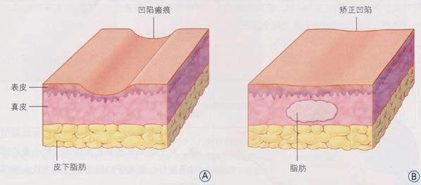 自體脂肪填充是將身體其他部位的脂肪抽取出來,經過提取,再注入需要