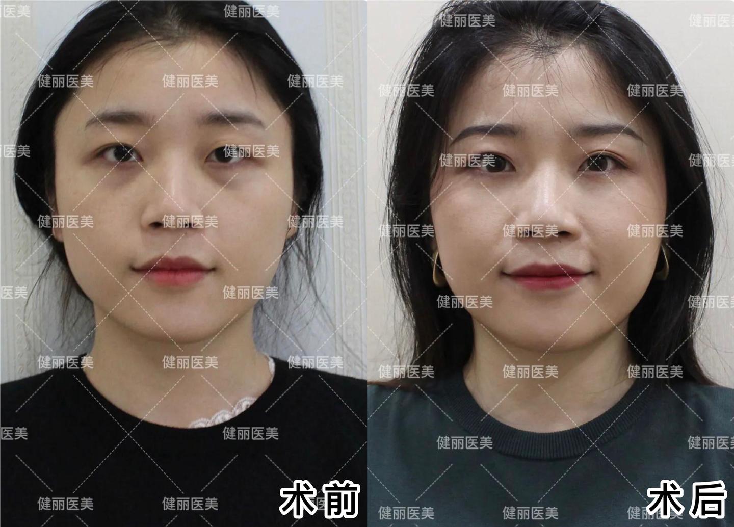 26岁女白领去眼袋的真实体验 看她说了什么 知乎 26岁女白领去眼袋的真实体验 看她说了什么 知乎
