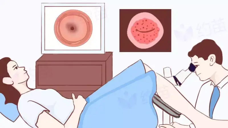 做了一次阴道镜发现我的宫颈竟然长这样