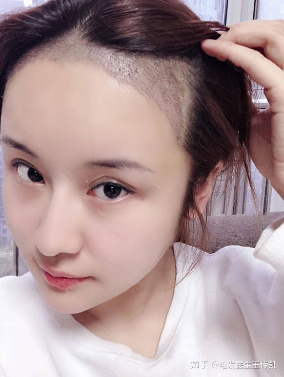 在太原雍禾植发的女生,改善发际线一年后怎么样了?