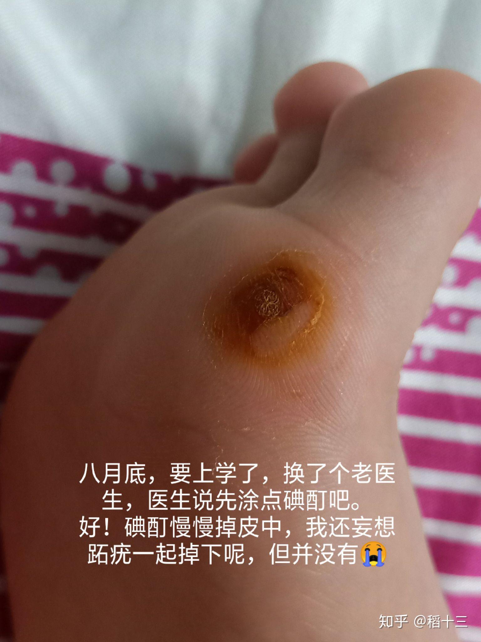 我的蹠疣應該是好了吧 希望不要復發5