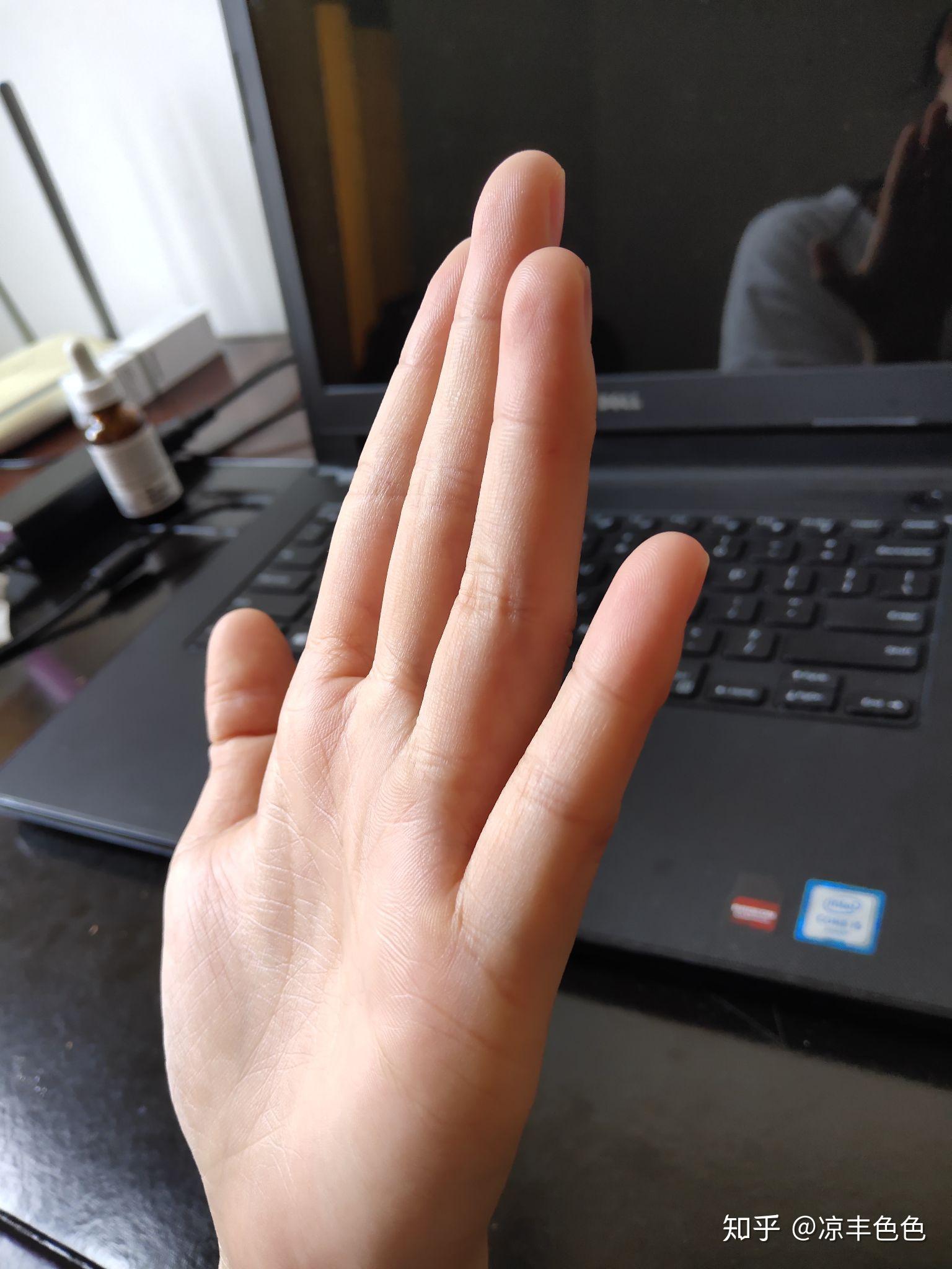 整形显微004：先天畸形---五岁小男孩双手“十二根手指头”