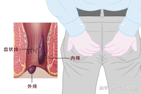 肠癌三多一痒图片