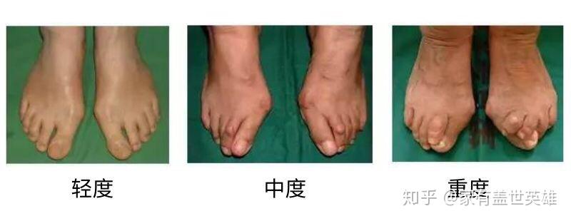 hva>35度,ima>16度,跖趾关节脱位已经属于叠趾畸形,属于重度范围.