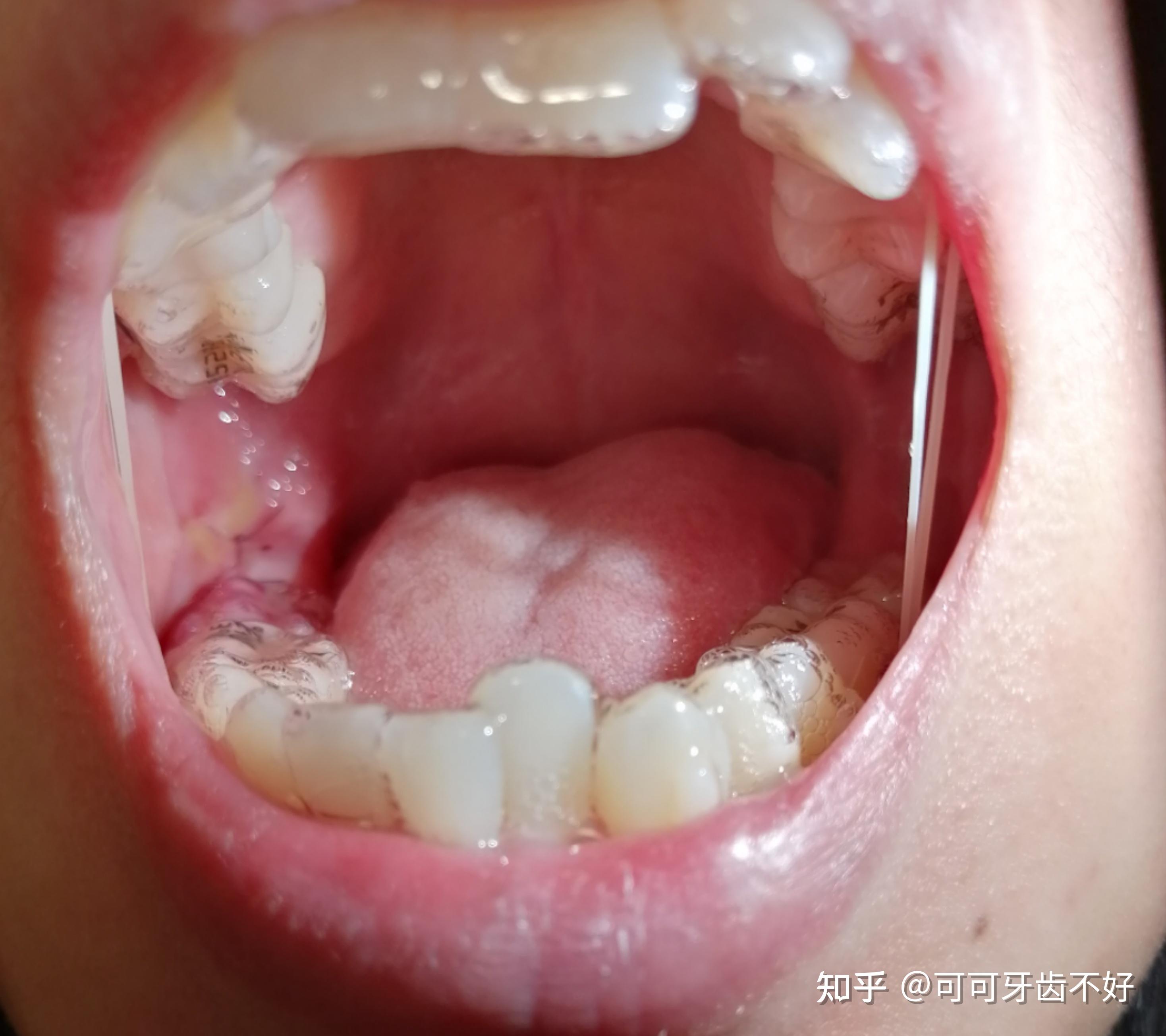 牙龈肿痛常见的表现有哪些症状（关于牙龈炎的介绍） - 搞机Pro网
