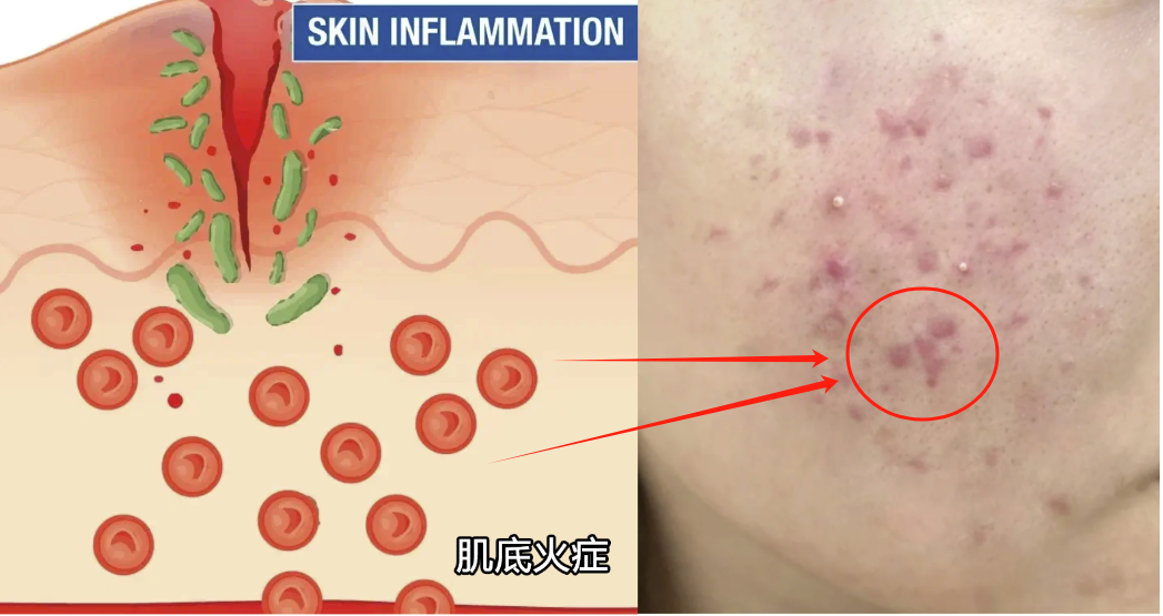 从医学角度来说，如何低成本的解决男士痘印？皮肤科医生教你最有效的男士祛痘印方法，28天还原光滑健康皮！不用美颜也能变帅！ 知乎