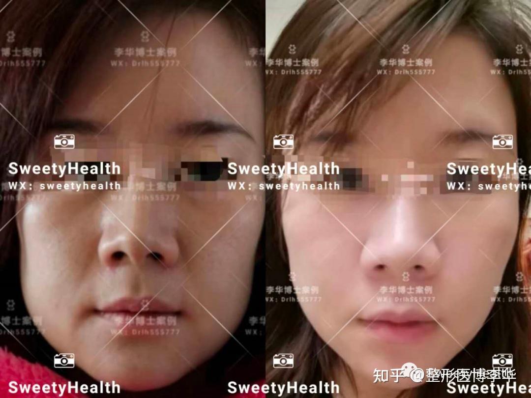 SVF脂肪胶填充案例分享 - 知乎