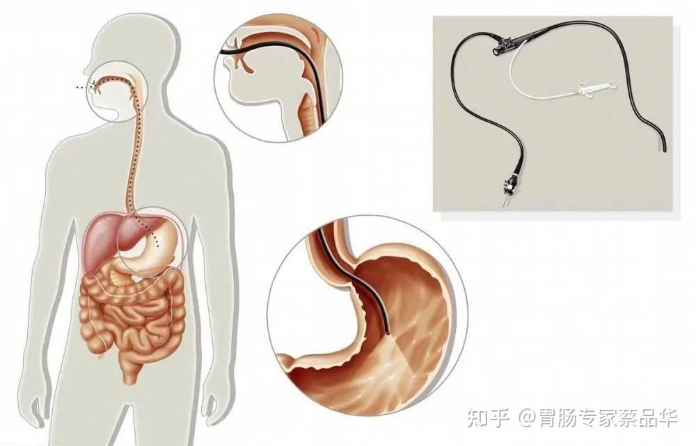 做胃鏡的注意事項