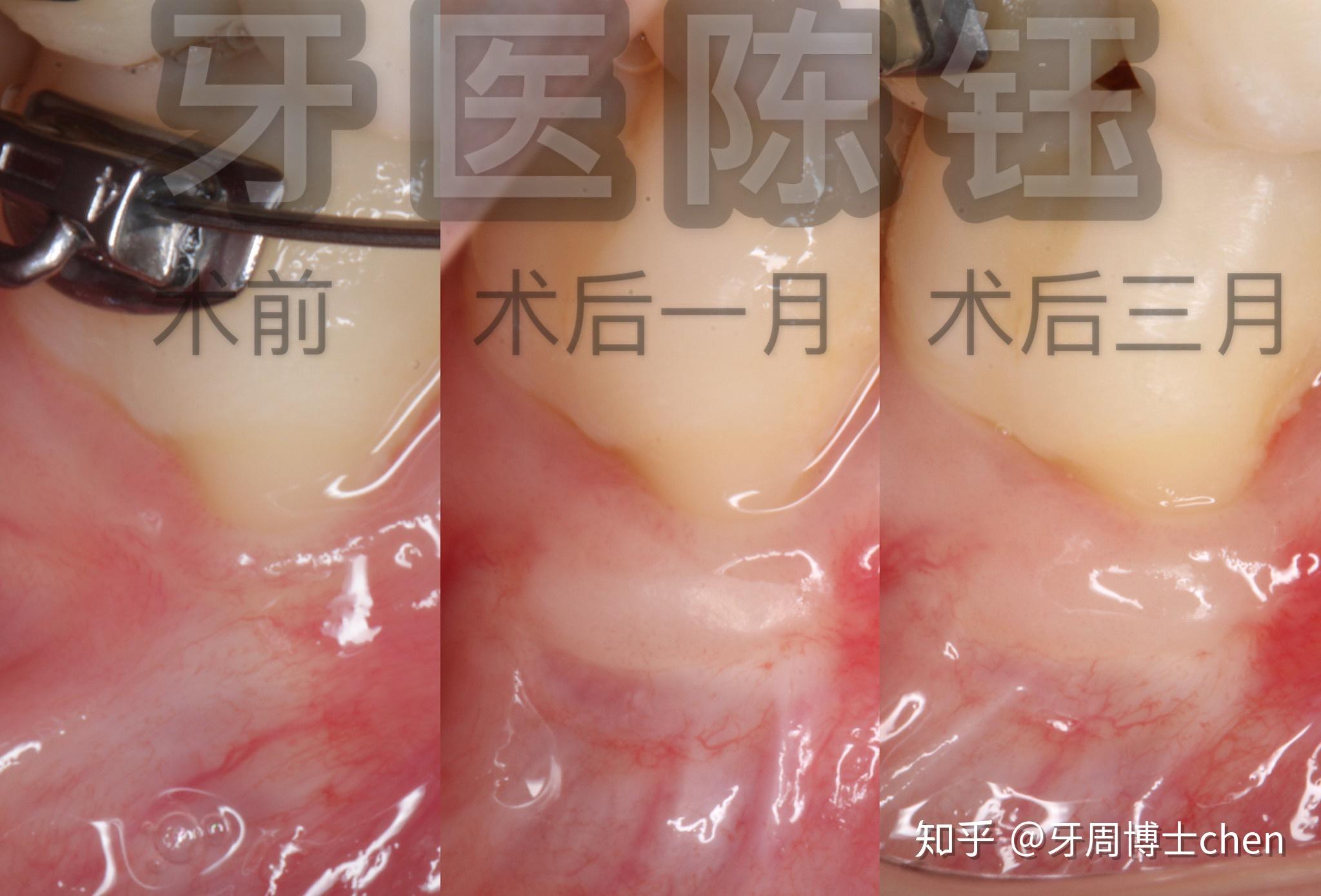 牙龈退缩的解决办法之一