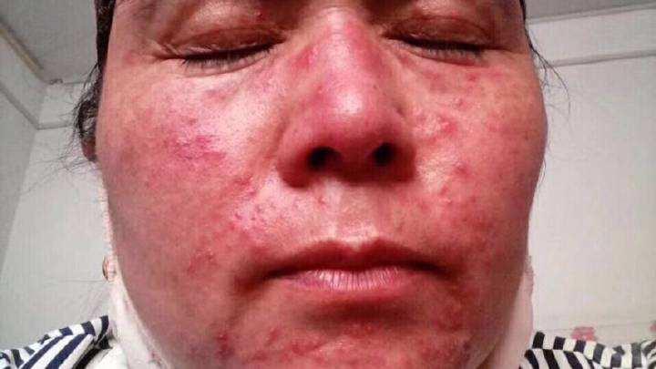 皮肤修复需多长时间 v2-53a2e04983d5639efa142986294b802a_1440w.jpg?source=172ae18b