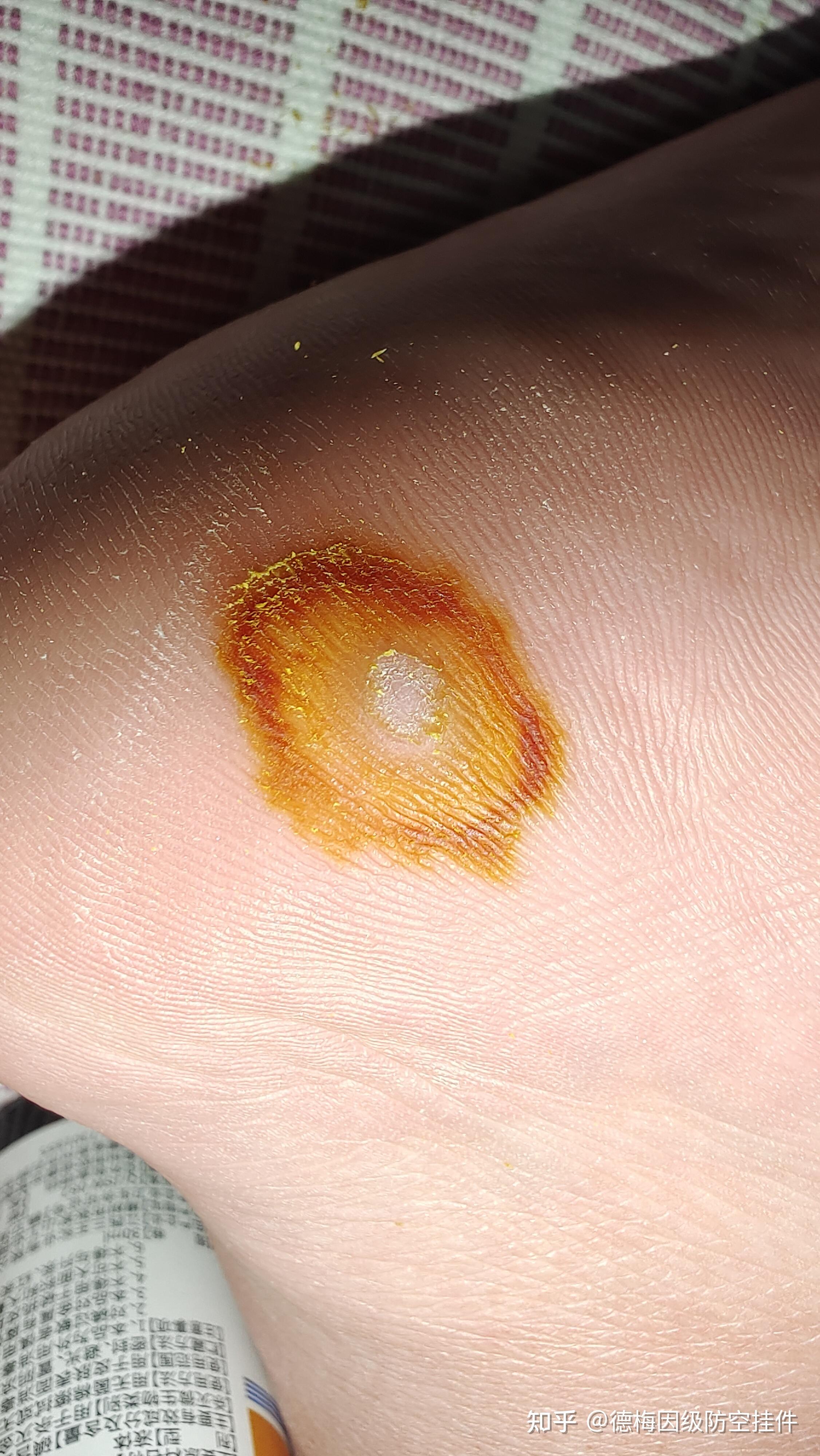 兄弟们又治好一个跖疣碘酊yyds