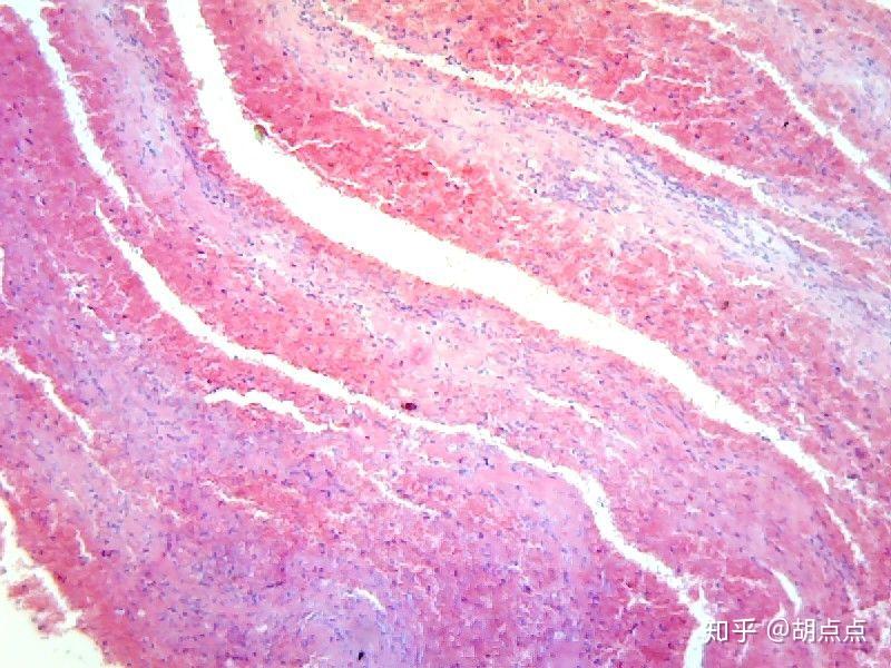 混合血栓切片图图片