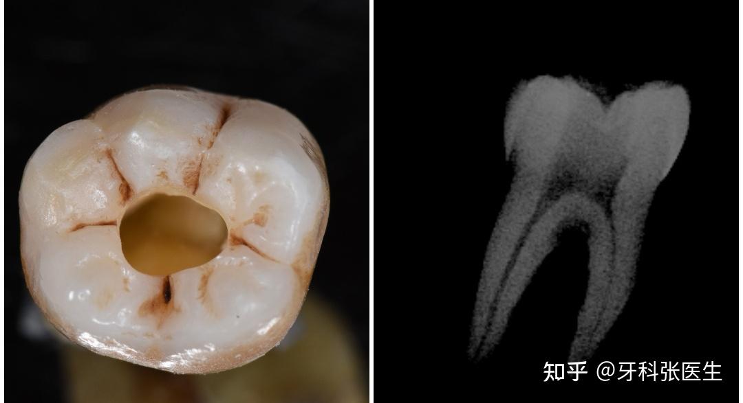 牙齿根管牙套图片