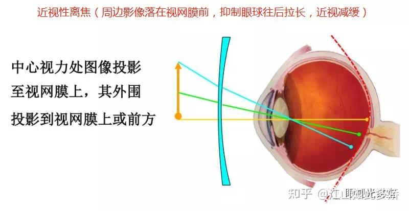 离焦,环焦,全焦镜片,你都了解吗?