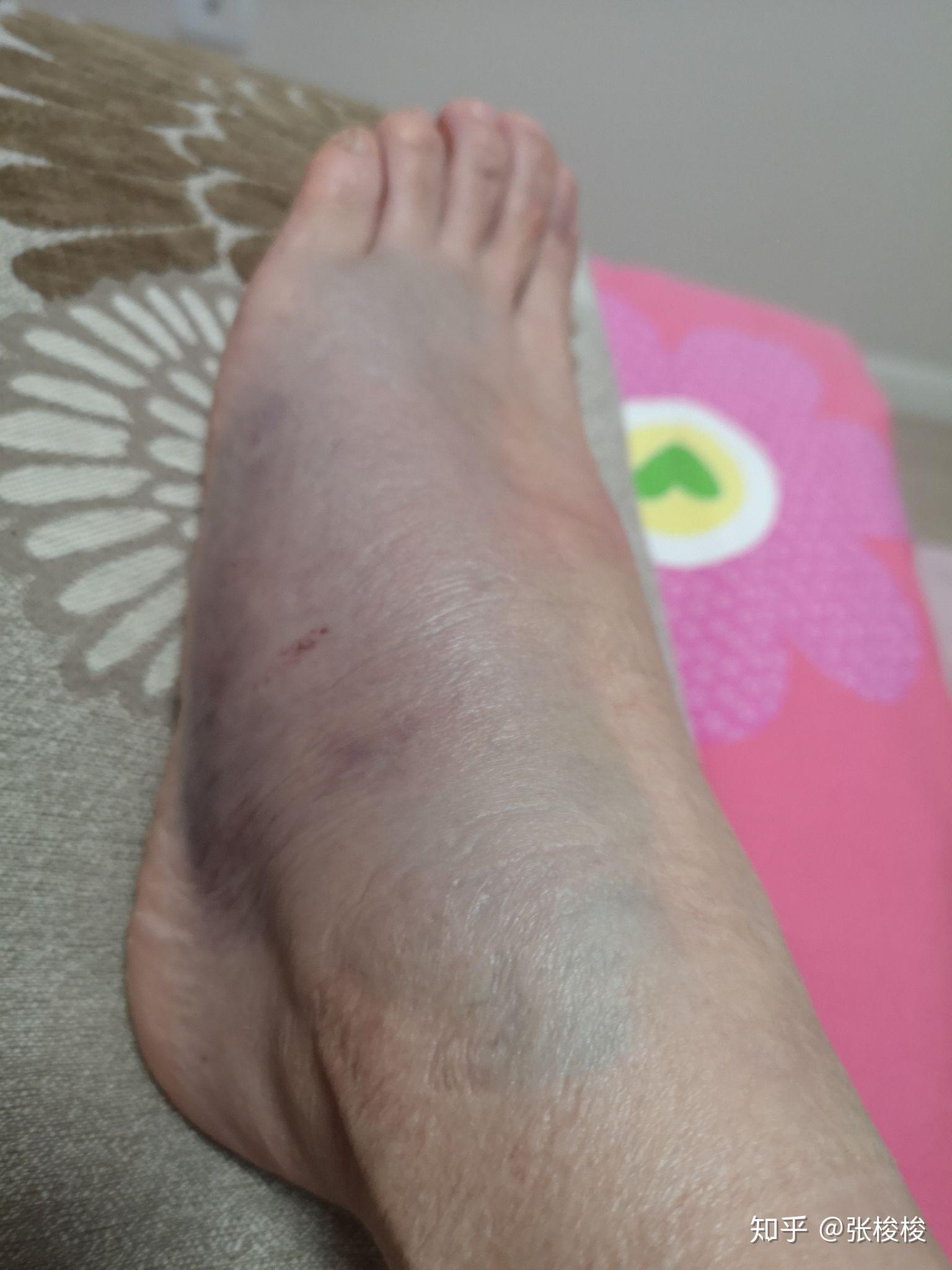今天感觉没有昨天肿了,但是淤青面积扩散,小腿围是35了,感觉这是手动