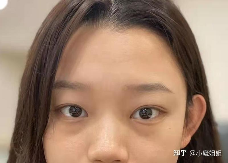 我的下眼袋是遗传性的,感觉10个眼袋9个遗传,加上年轻人嘛,都喜欢熬个
