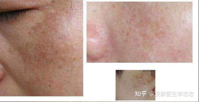 中医学对黄褐斑的认识 - 知乎