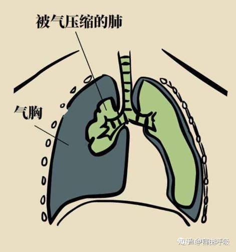 气胸穿刺部位示意图图片