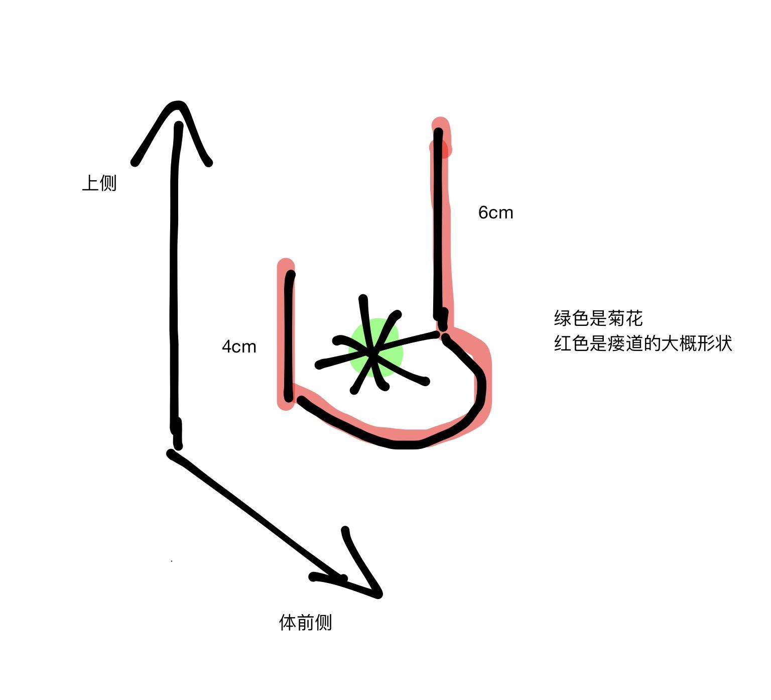 马蹄形肛瘘图片图解图片