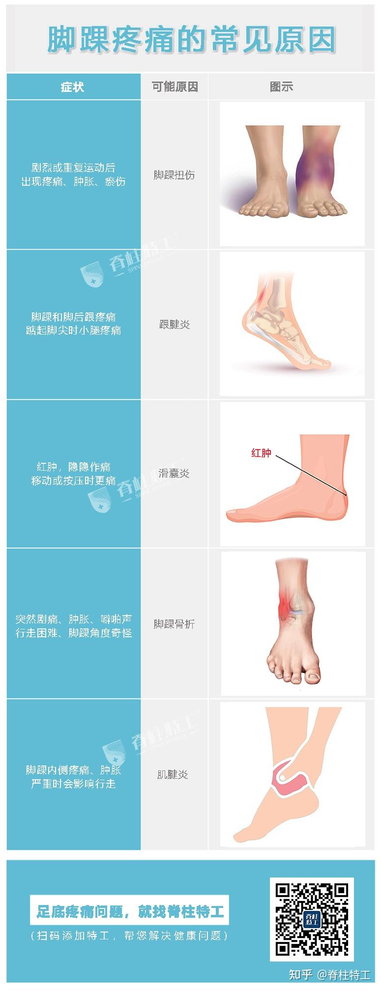 【足部疼痛地图】教你看懂脚痛对应的常见病症 - 知乎