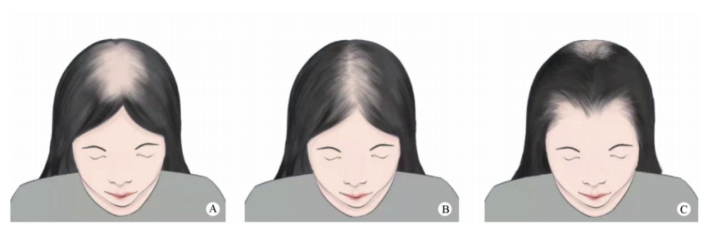 如何判断自己脱发？| 收下这份「生发宝典」，让你告别掉发烦恼！ - 知乎
