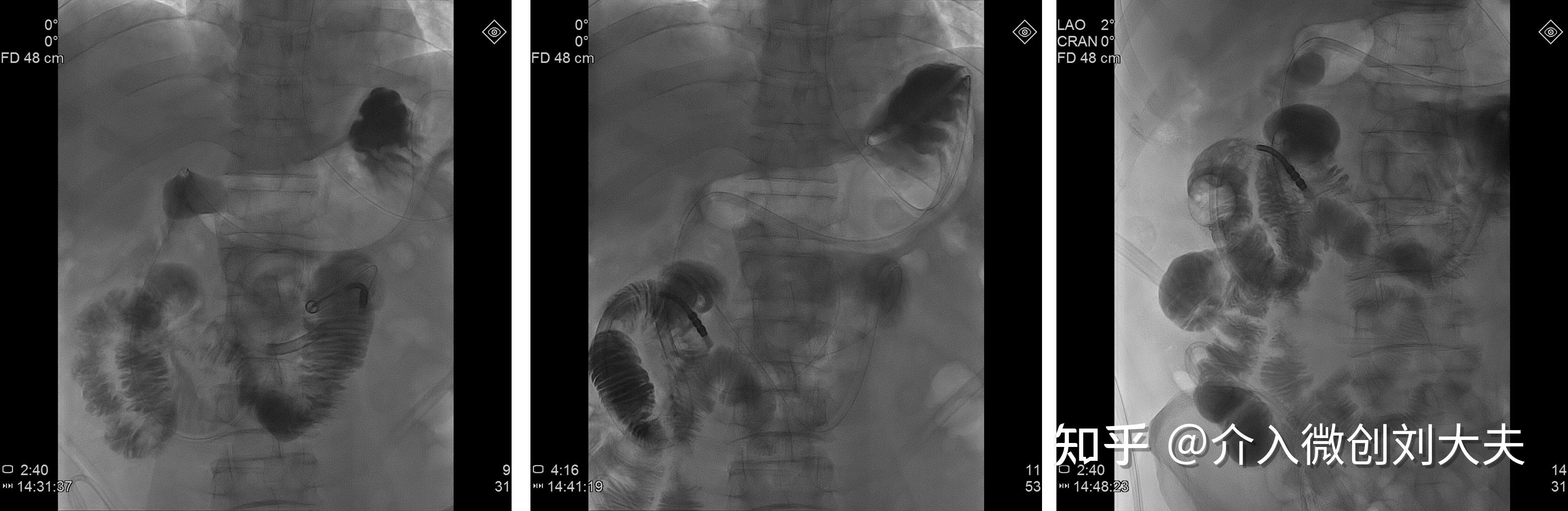 【急诊】腹部平片--肠扭转，大肠梗阻，中毒性巨结肠，腹膜后积气