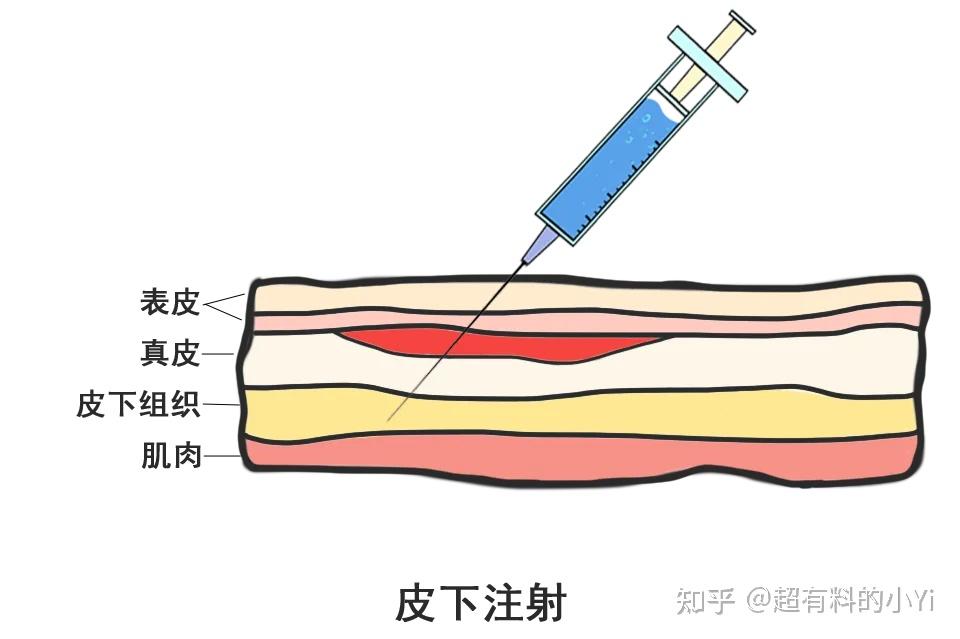 四大注射的角度图片