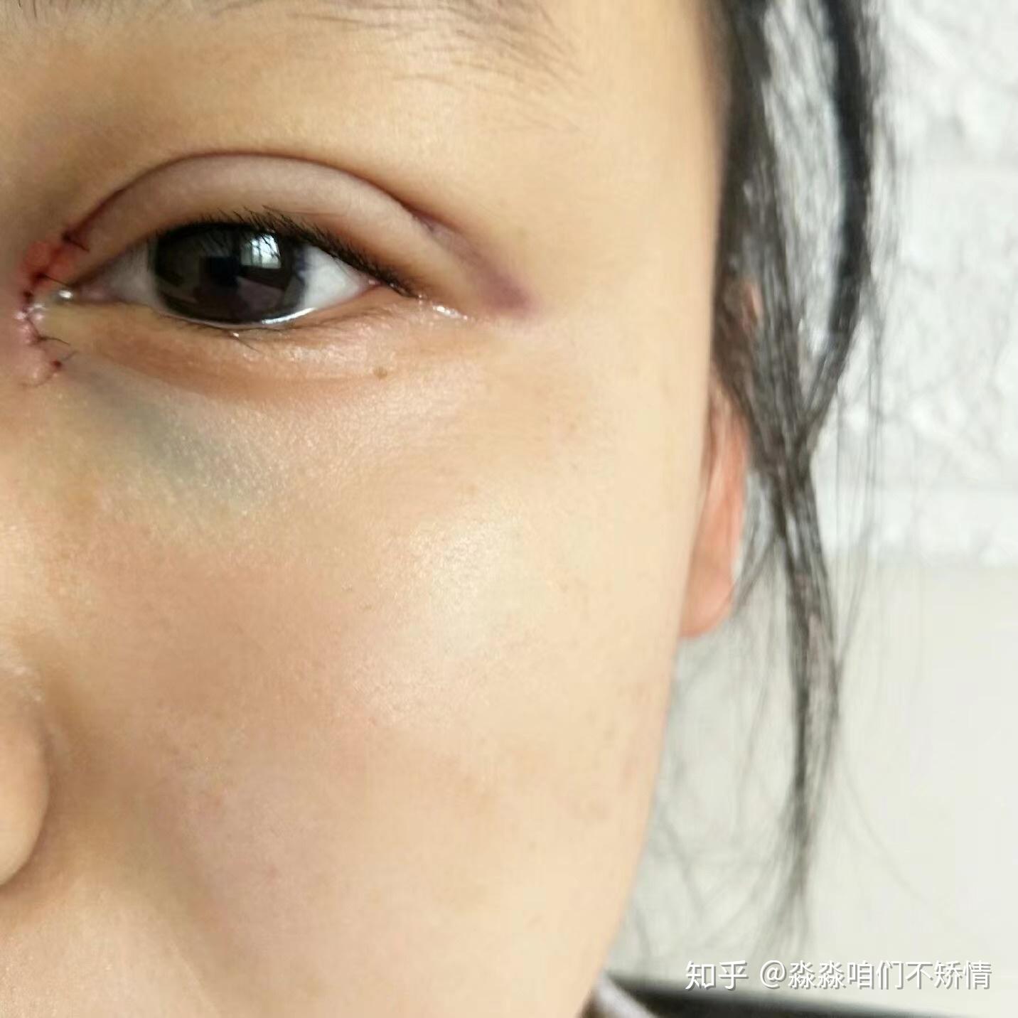 大家割完双眼皮之后线头会不会竖起来