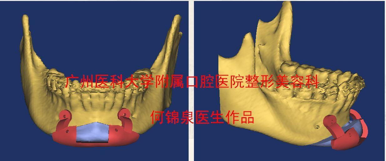 3d打印导板颏成型下巴截骨手术示意