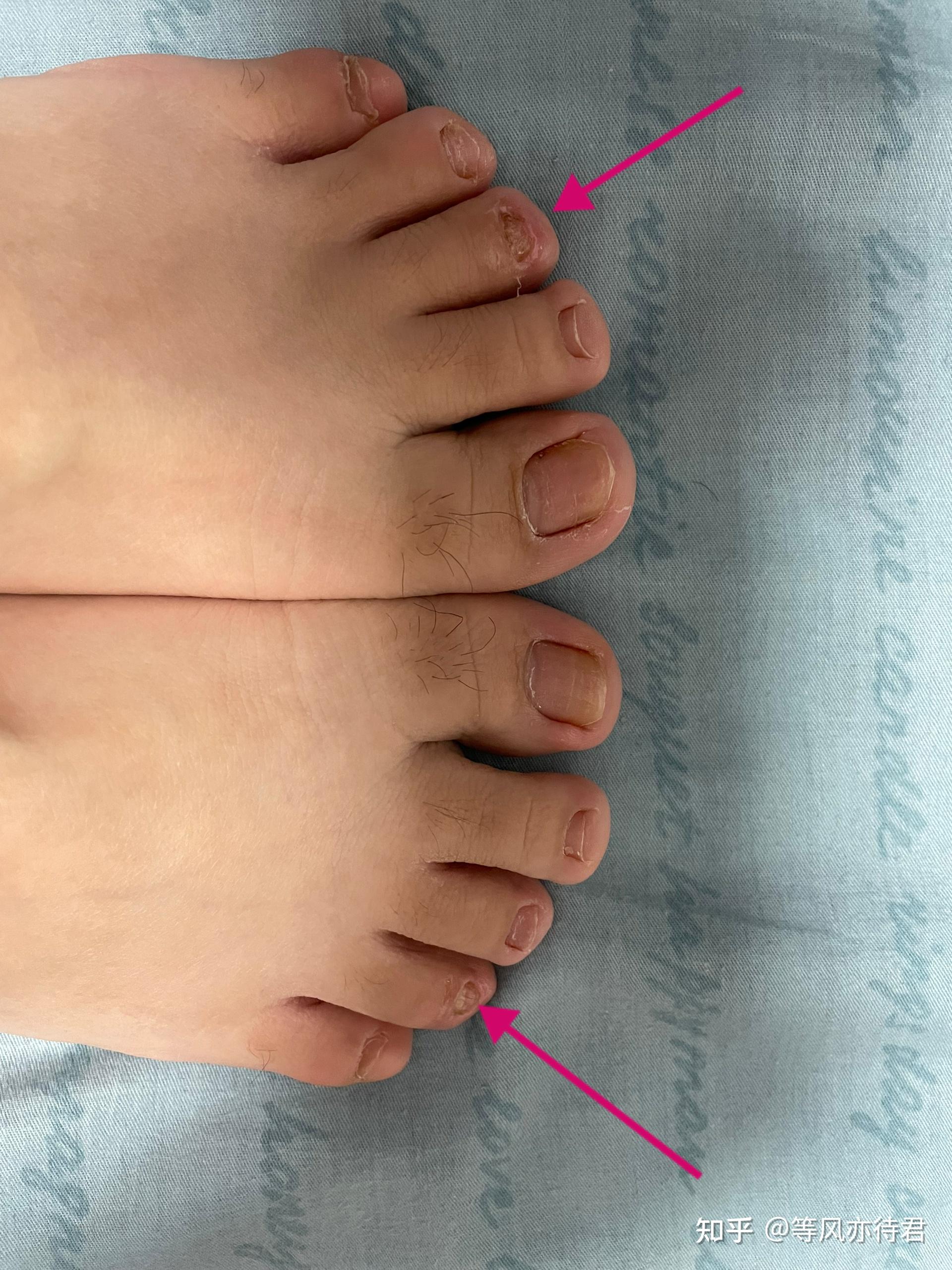 阿莫罗芬搽剂治疗灰指甲