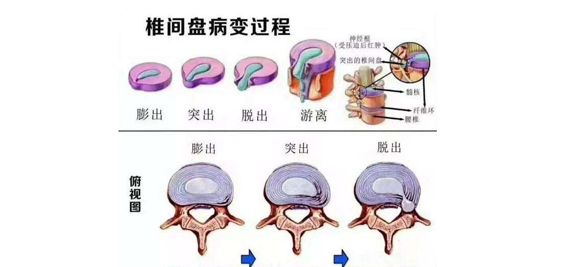 中醫治療腰椎間盤突出症中醫治療方法