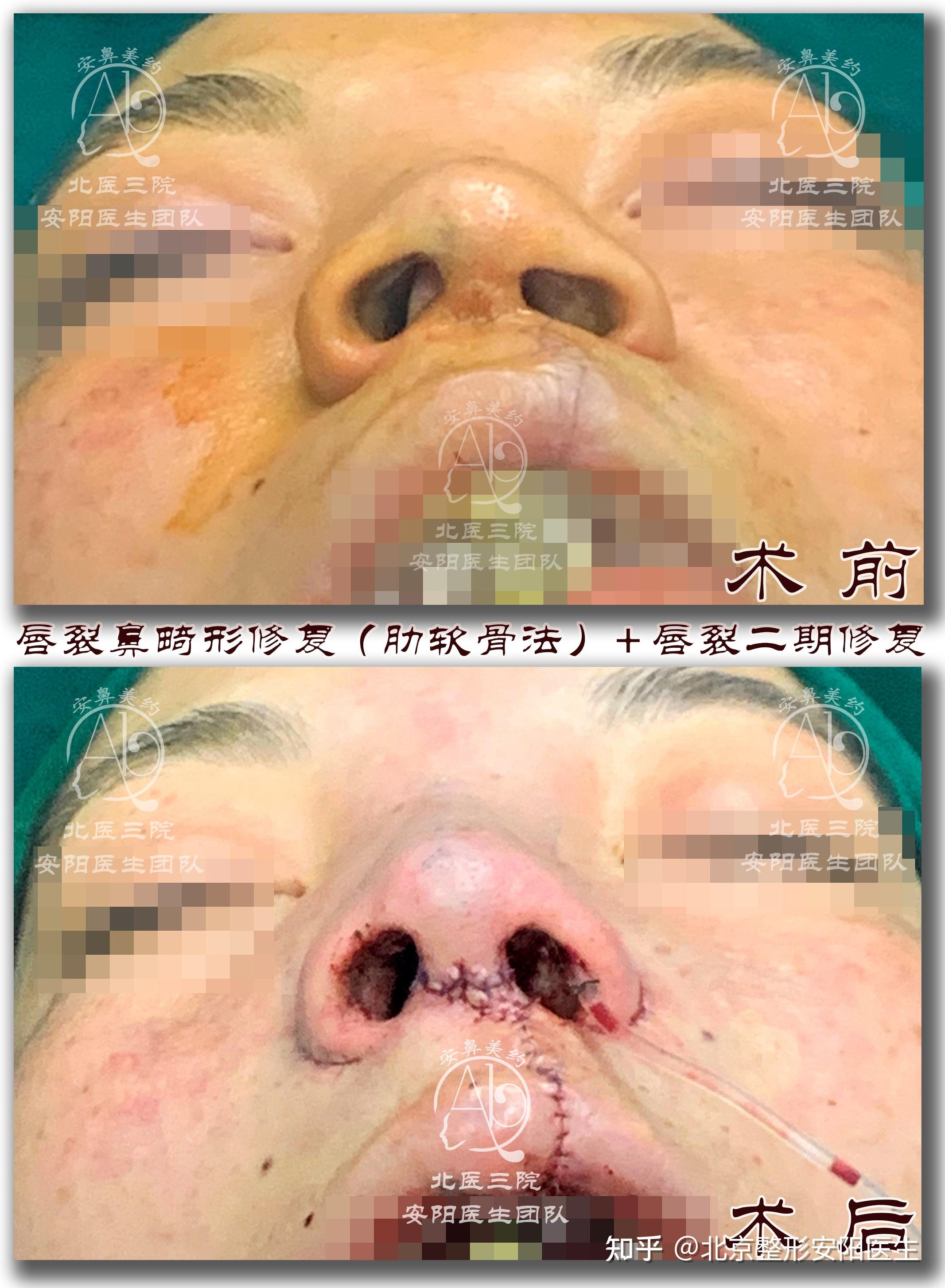 畸形修復術(肋軟骨法) 膨體隆鼻背 唇裂二期修復 歪鼻矯正 寬鼻截骨