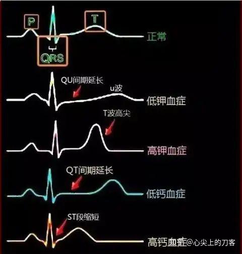 右心功能衰竭怎么办