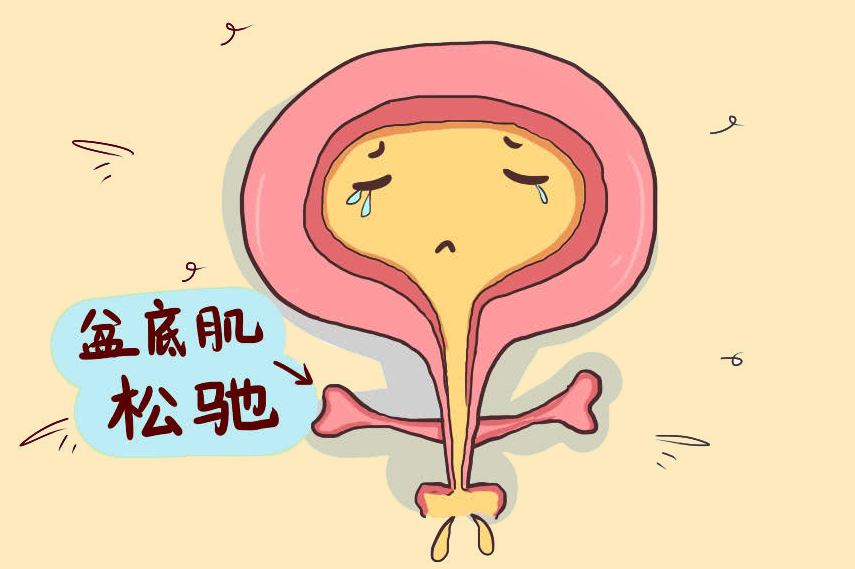 咳嗽漏尿打喷嚏漏尿女性压力性尿失禁怎么办
